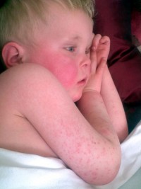 Boy with scarlet fever