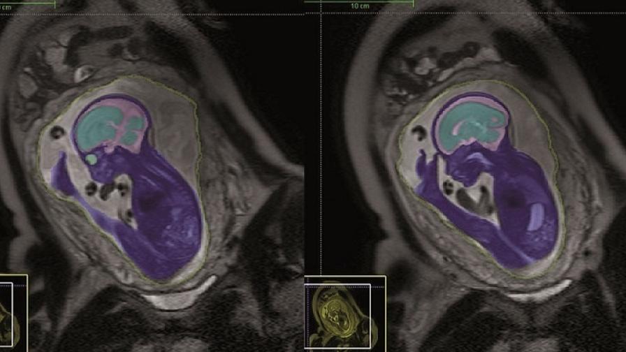 Fetal MRI scans showing a baby and its brain inside the womb