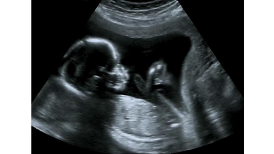Ultrasound of baby