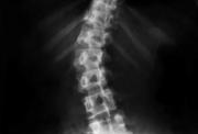 X-ray image of a childs spine
