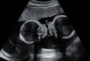 View of twins in an ultrasound scanner screen