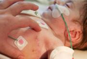 A baby with monitoring devices stuck on their body and a breathing tube in their nose