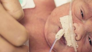 A newborn baby with a breathing tube in their nose