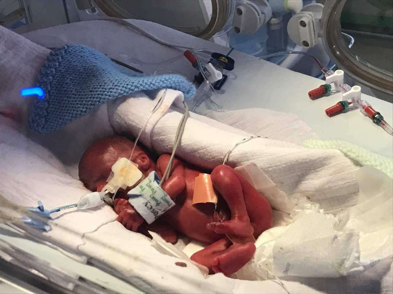 New born baby in an incubator with breathing tubes and monitoring wires