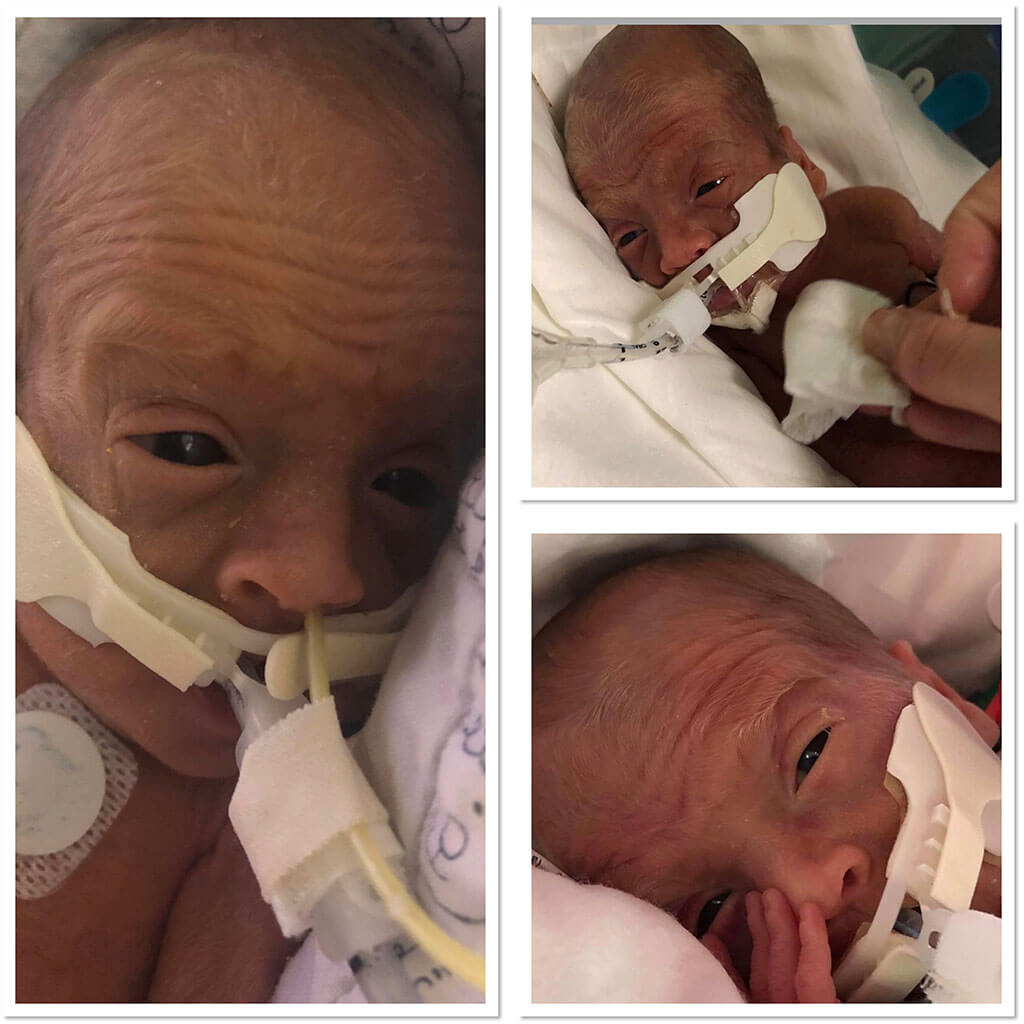 Collage of of three pictures of Zachary in an incubator